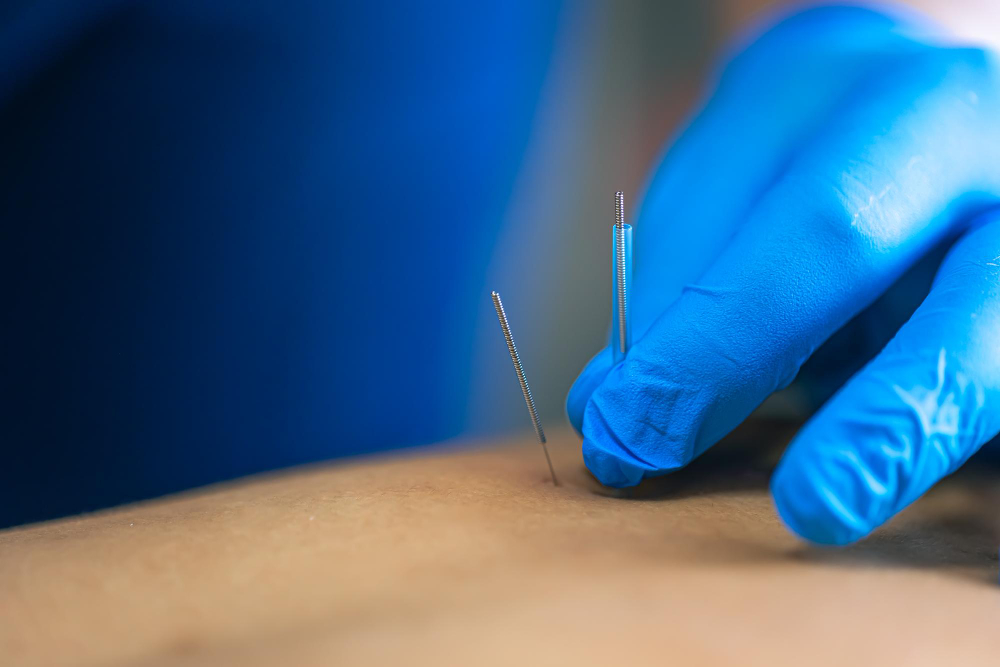 Dry Needling  Bay City, TX